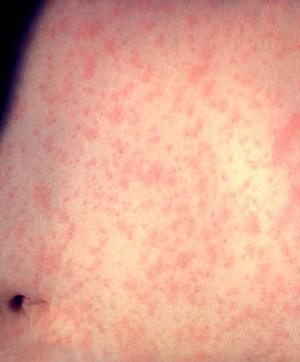 people_measles9_300